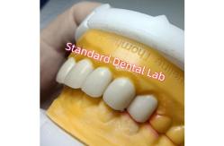 China Ivoclar Zirconia Crown Veneers High Translucency Esthetic supplier