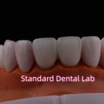 Tranlucent Emax Zirconia Laminate Veneers Porcelain Dental Veneers Chemically Verystable for sale