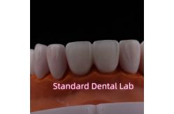 China Abrasion Resistant Emax Zirconia Laminate Veneers Incisal Translucency supplier