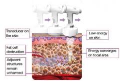 China factory hifu high intensity focused ultrasound hifu supplier