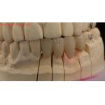 Solid Dental Lab Crowns 3D Pro High Translucency Full Zirconia Crowns with Vita Shade Customized for sale