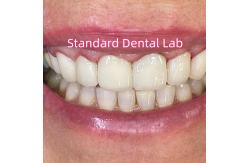 China Ivoclar Zirconia Crown Veneers High Translucency Esthetic supplier