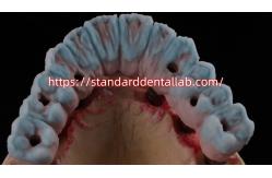 China Implant Supported Zirconia Bridge With Titanium Abutment High Esthetics supplier