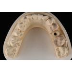 Sandblasted Single Tooth Implant With Self Tapping Thread And Internal Hex Connection