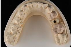 China Sandblasted Single Tooth Implant With Self Tapping Thread And Internal Hex Connection supplier