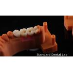 Screw Retained Dental Implant Crown with PFZ Porcelain Layered Zirconia 5-Year Gurantee and 3D Print Model for sale