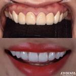 CAD/CAM Compatible Zirconia Dental Crowns Precision Manufacturing For Tailored Shades And Sizes for sale