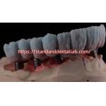 Implant Supported Zirconia Bridge With Titanium Abutment High Esthetics for sale