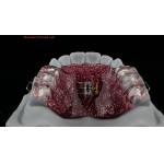 Teeth Expansion And Distalization Adjusting Expander In Mouth Orthodontist Palate Expander for sale