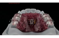 China Teeth Expansion And Distalization Adjusting Expander In Mouth Orthodontist Palate Expander supplier