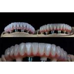 10mm Multiple Teeth Two Stage Dental Implant Kit For Endosseous Prosthetic Crown for sale