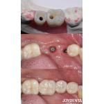 Cylindrical All On 4 Titanium Dental Implants 10-16mm Length Hex Connection for sale