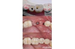 China Cylindrical All On 4 Titanium Dental Implants 10-16mm Length Hex Connection supplier
