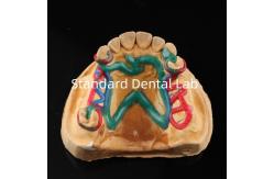 China Cobalt Chrome Framework Ni Be Free removable dental prosthesis China Dental Lab supplier