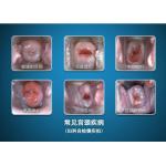 High Definition Display Digital Electronic Colposcope Portable Device to Check Cervix and Vagin for sale