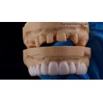 High Esthetics Dental Snap On Smile Standard Dental Lab Removable Dental Appliance for sale