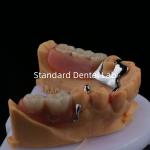 China Alloy Metal Partial Denture Framework 3 Shape Exocad Laser Printing Lower Cast Partial Finish manufacturer