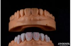 China Secure Fit Porcelain Veneers Ceramic and Natural Aesthetics with Strong Adhesion supplier