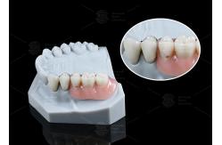 China MK1 Attachment Dental Prosthesis Silver Partial Denture Precision Attachments supplier