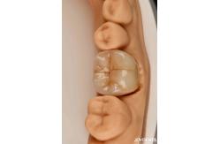 China Natural-looking Multilayer Full Zirconia For High Strength And Durability supplier