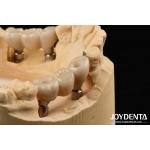 Zirconia Implants Perfect Match With Natural Teeth Zero Allergy Risk for sale