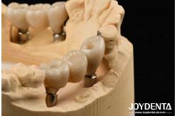 China Zirconia Implants Perfect Match With Natural Teeth Zero Allergy Risk supplier