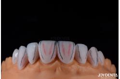 China Secure Fit Porcelain Veneers Ceramic and Natural Aesthetics with Strong Adhesion supplier