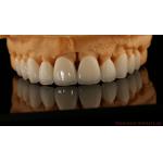 Full Contour Dental Lab Crowns High Translucency Solid Zirconia Crown China Dental Lab for sale
