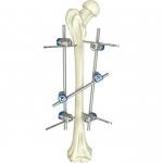 Basic Orthopedic Instrument Set Surgical Femoral Shaft External Fixation Device for sale