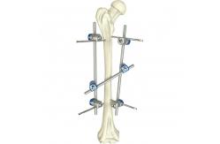 China Basic Orthopedic Instrument Set Surgical Femoral Shaft External Fixation Device supplier