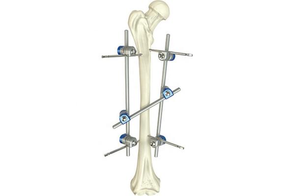 Basic Orthopedic Instrument Set Surgical Femoral Shaft External Fixation Device
