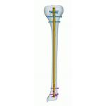 Titanium CE Anatomic Tibia Interlocking Nail for sale