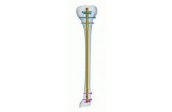 China Titanium CE Anatomic Tibia Interlocking Nail supplier