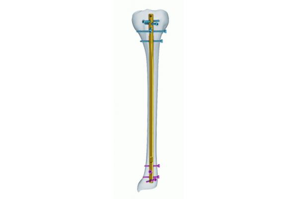 Titanium CE Anatomic Tibia Interlocking Nail