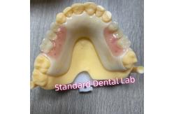 China Upper Tooth Shade Acetal Framework Acrylic Clasp Removable Partial Dentures supplier