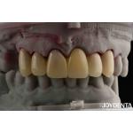 CAD CAM Processing Dental PMMA Material Multilayer Design For Natural Shade Transitions for sale
