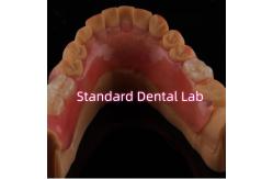 China High Esthetic Flexible Valplast Partial Denture Easy To Clean supplier