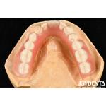 Diverse And Lightweight Resin Material Acrylic Denture Finish for sale