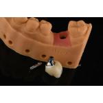 Precision Cylindrical Silver Single Tooth Replacement Implants Dental Restoration for sale