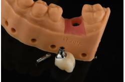 China Precision Cylindrical Silver Single Tooth Replacement Implants Dental Restoration supplier