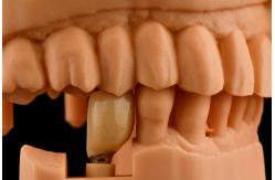 China Internal Hex Connection Sandblasted Titanium Dental Implants Single Tooth Replacement supplier