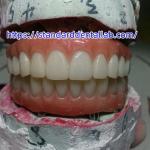 Dental Implant Temporary Crown PMMA Bridge With Pink Porcelian for sale