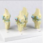 Four Stage Pathological Learning Knee Model Anatomy for sale