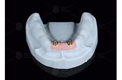 China Overdenture Locator Attachments Titanium Bracket Locator Denture Attachments supplier