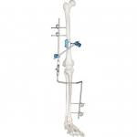 Medical Knee Joint External Fixation Device Orthopedic Surgical Instruments for sale