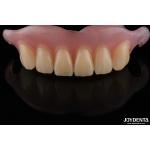 Personalized Invisible Denture Finished With Advanced Tooth Arrangement Technology
