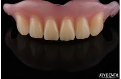 China Personalized Invisible Denture Finished With Advanced Tooth Arrangement Technology supplier