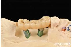 China Implant Crown And Bridge With Customizable Design High Durability Accurate Fit supplier