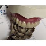 Complete Denture Permanent Esthetics Acrylic Partial Denture for sale