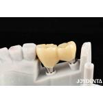Experience Aesthetically Pleasing Results With Customizable Implant Retained Crown And Bridge